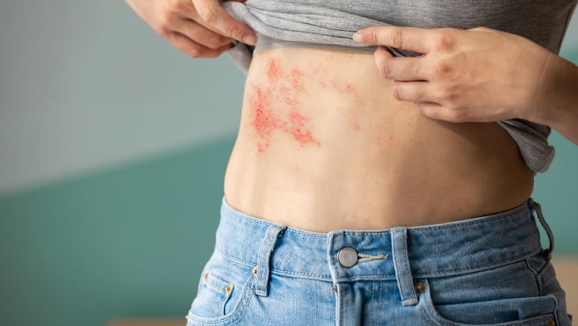 Why shingles hits harder with diabetes