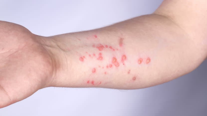 Kelantan siap siaga lakukan ujian saringan cacar monyet di pintu sempadan 