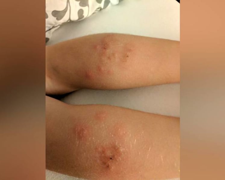 Bed bugs on planes: How to spot the signs and why they are 'almost impossible' to prevent