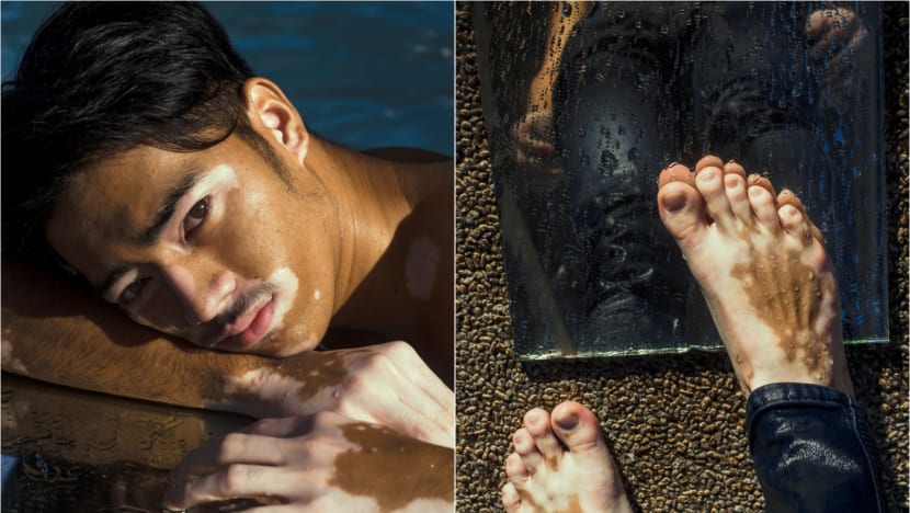 Unwanted stares and missed job opportunities: What it is like to live with vitiligo