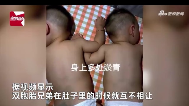从娘胎就“相爱相杀” 中国双胞胎出生全身瘀青 