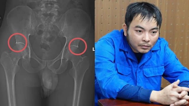 敲断保户骨头骗保险  越南团伙诈领逾29万元赔偿金