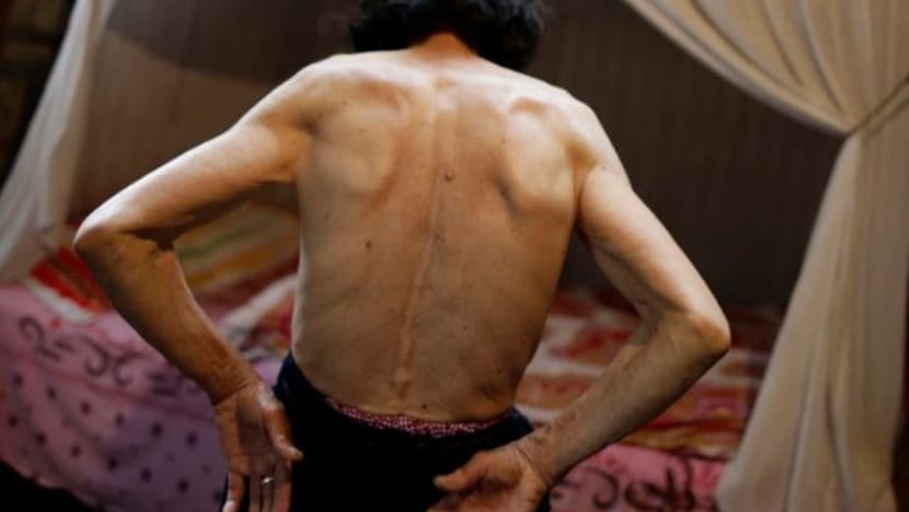 Increase in younger patients diagnosed with skin cancer