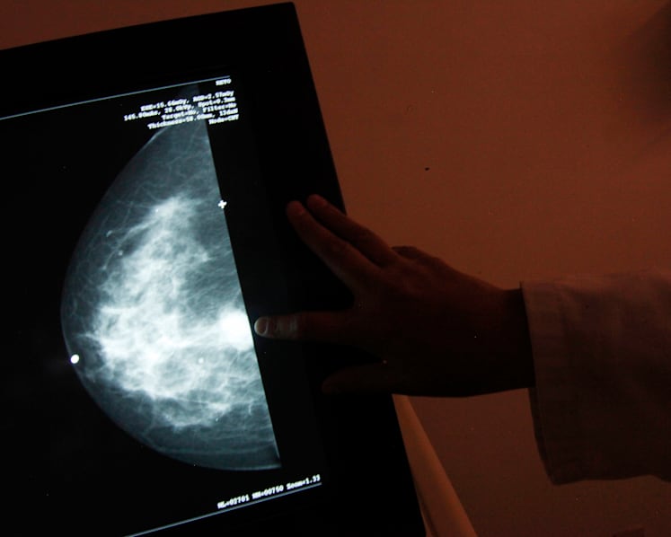 Breast cancer survivor thought she ‘could live with one breast’, but later felt incomplete