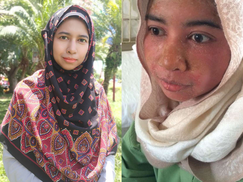 She got her master’s degree and raised four children, even as she battled a painful, incurable skin disease