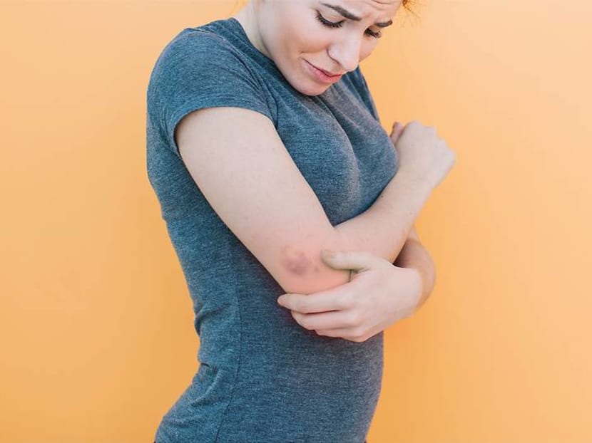 Why do some people get bruises easily – and when should you go see a doctor?