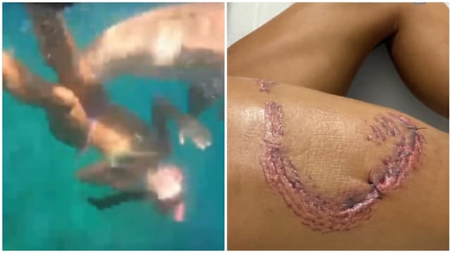女子在巴西海岛浮潜突遭鲨鱼猛咬 腿上数十道锯齿状伤痕