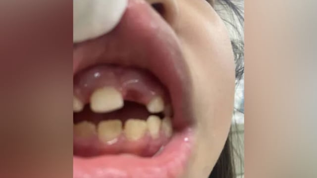 疑因吃饭太慢 台女童被幼儿园老师打掉门牙