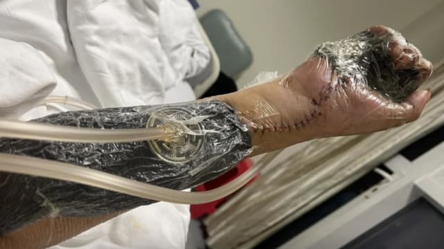 上班六天误触辐射源 中国男子即将截肢