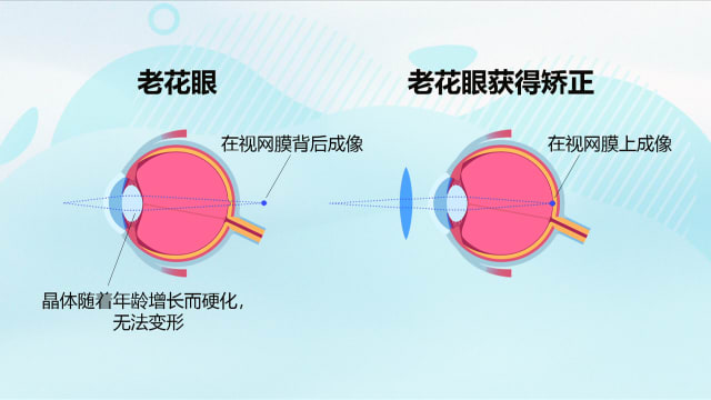 狮城有约 | 别任由老花眼变严重 医生告诉你更多好方法