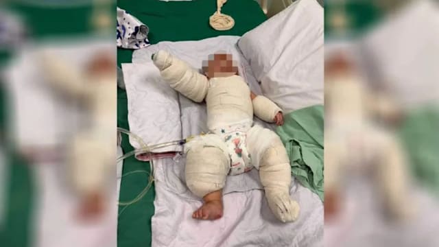 马国男婴误扯电饭锅电线 热饭翻倒烫伤全身