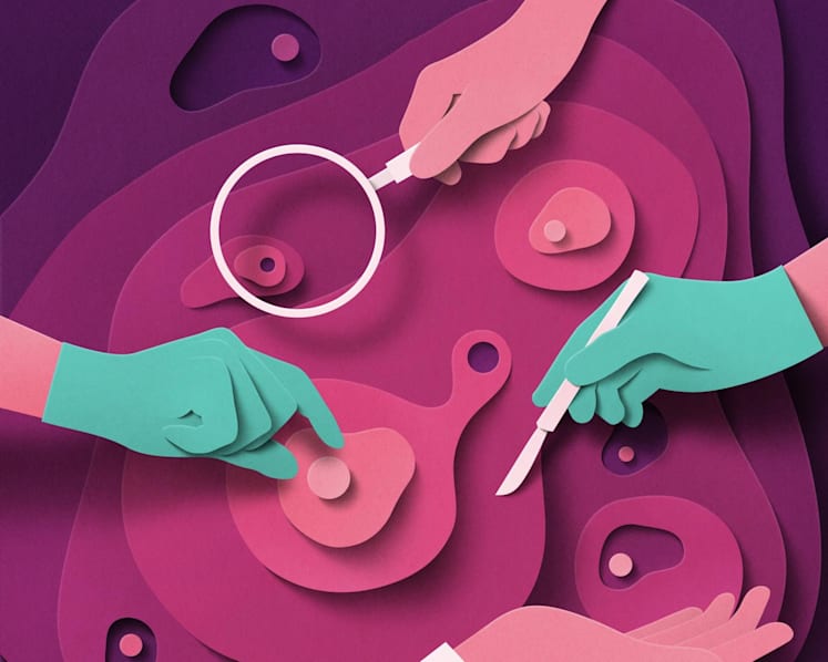 To treat prostate cancer, there are more options than ever