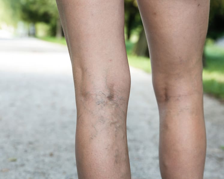 Experiencing painful, heavy periods? You might have varicose veins in the pelvic area
