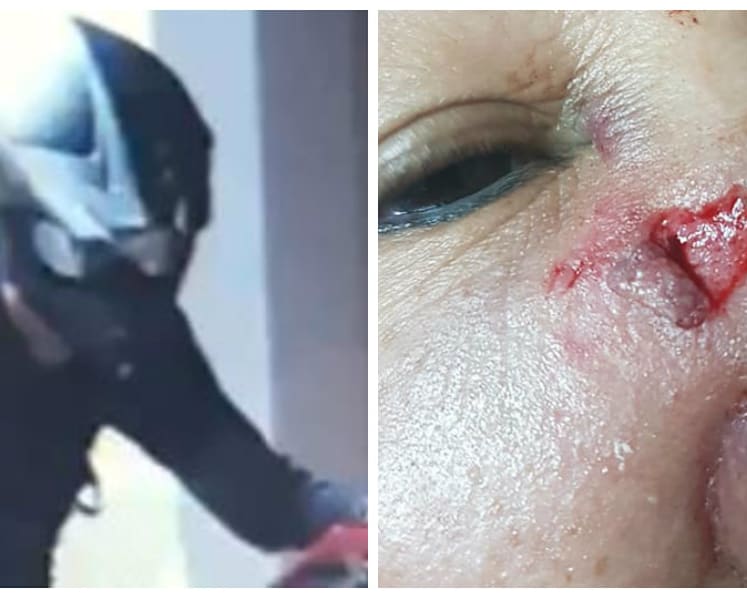 Elderly woman suffers multiple injuries after being hit by e-scooter