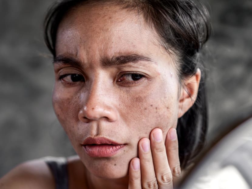 Melasma isn’t just a pregnancy thing, it can happen to any woman. And it’s all because of our hormones 