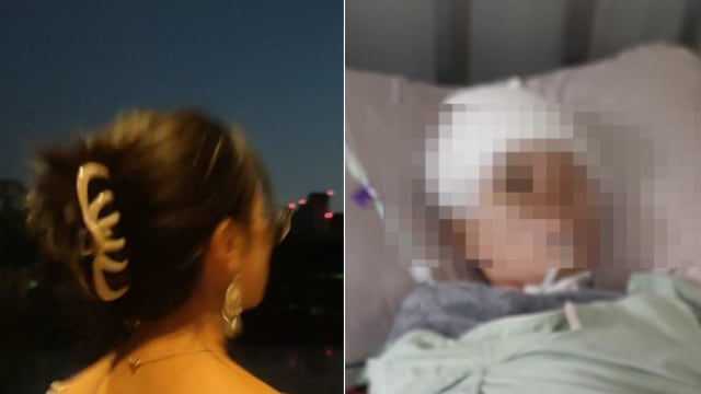 中国情侣从摩托车摔倒 女友被鲨鱼发夹“咬”至重度昏迷