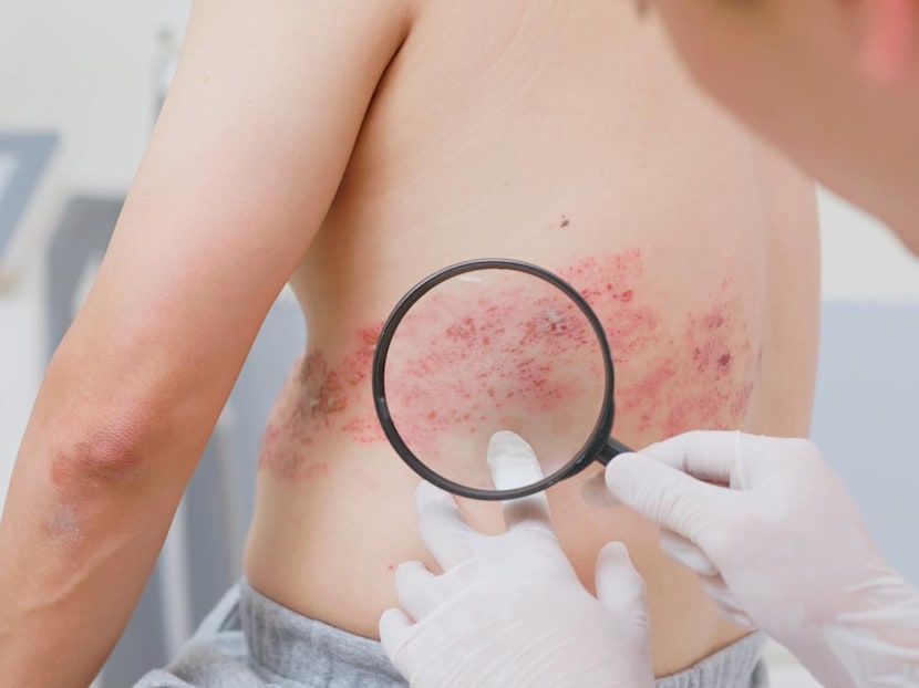 Shingles vaccine linked to fewer heart attacks and strokes, study suggests – what you need to know