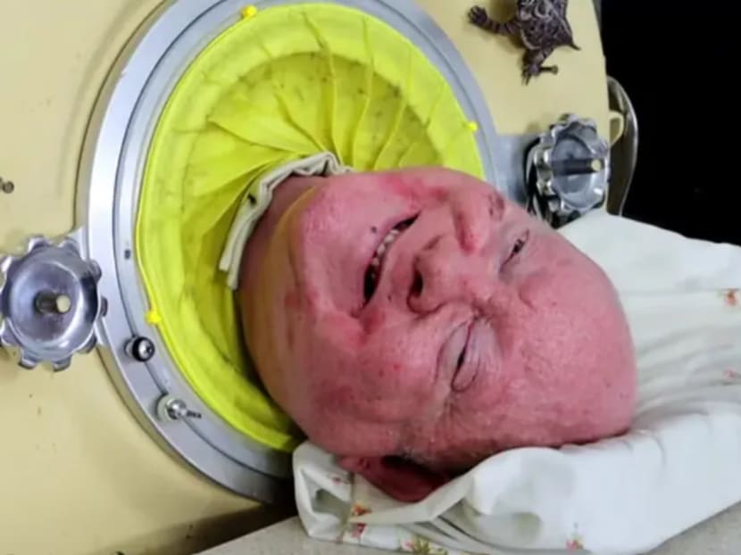 Paul Alexander contracted polio at the age of six, leaving him paralysed from the neck down and reliant on a mechanical respirator to breathe for much of the time. Paul Alexander contracted polio at the age of six, leaving him paralysed from the neck down and reliant on a mechanical respirator to breathe for much of the time.