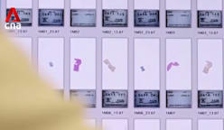 Moderna, Merck say mRNA treatment cuts risk of melanoma recurrence, spread 
