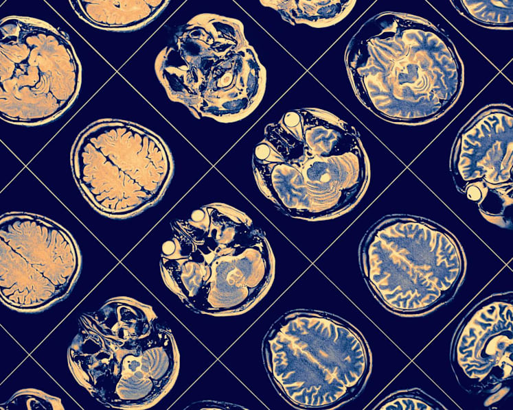 Singapore researchers identify two genes associated with risk of schizophrenia