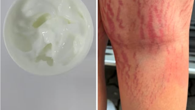 三款草药产品含违禁成分 男童用后爆肥还长妊娠纹