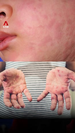 What to know about measles protection