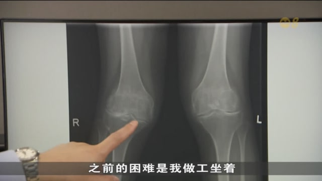 中央医院：60岁以下骨关节炎患者占约两成 