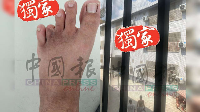 受困两年揭缅园区黑幕 马国青年遭暴打近乎失明