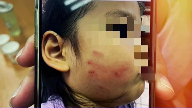 幼儿园女童午休拒睡觉 老师怒掴脸留“恐怖血指印”