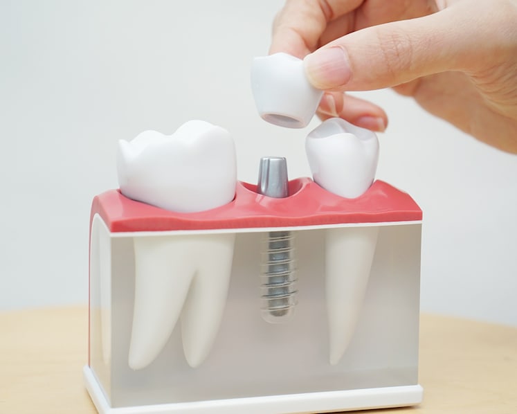 Dental implants costly, but gaining popularity among baby boomers