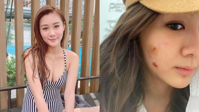 陈诗欣“自毁形象”　大晒毁容烂脸照