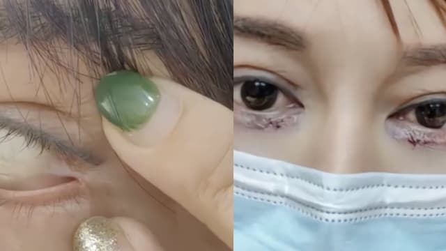 中国女子花3万元割双眼皮 眼球和眼皮被缝一起
