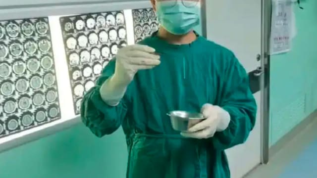 疑用井水刷牙致寄生虫入脑 中国男子脑中被取出十厘米活虫