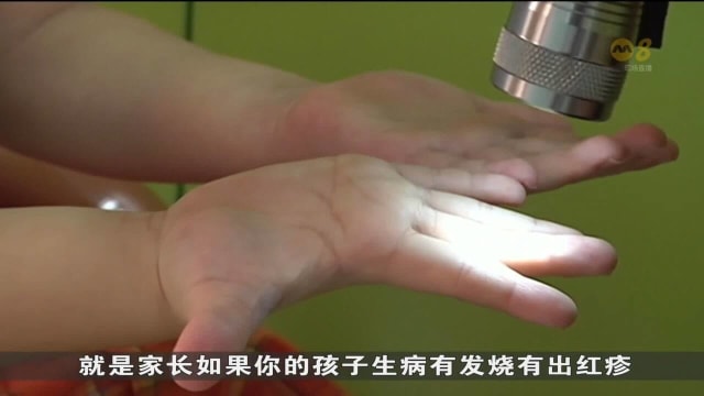 本地手足口症病例持续增加 儿童诊所和幼儿园严阵以待