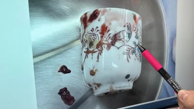 台男肛门卡8公分高陶瓷杯  医生开腹手术取出