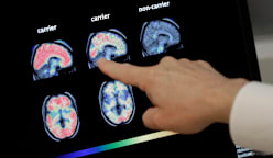 Commentary: Fighting dementia could be as easy as the shingles vaccine