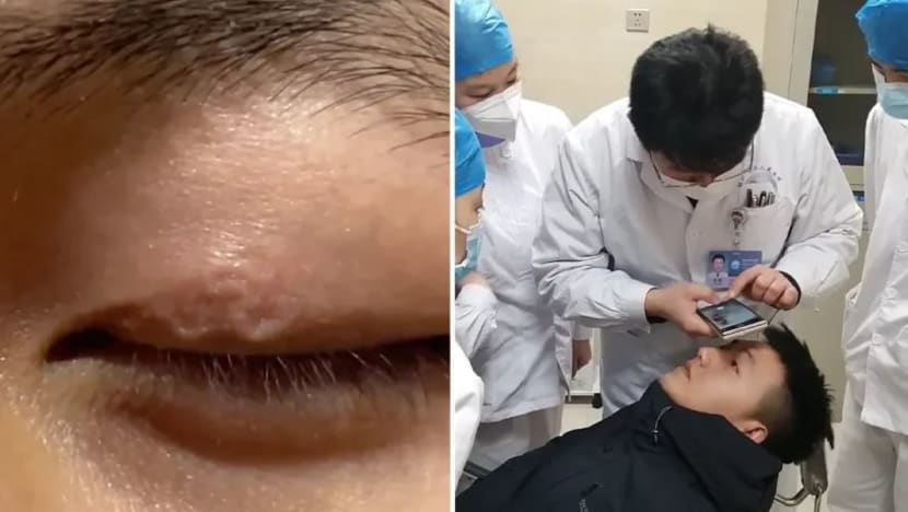 Cacing parasit di bawah kelopak mata, lelaki rayu bantuan bila doktor tiada rawatan