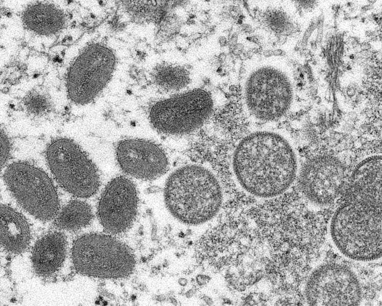 No monkeypox infections detected in Singapore since imported case in 2019: MOH