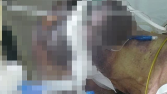 食用“黑布丁“后四肢发紫  越南男多重器官衰竭致死