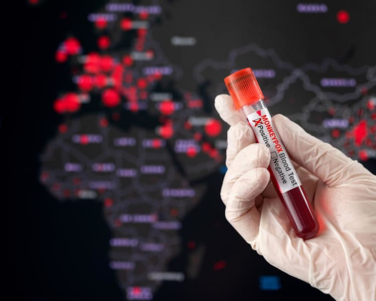 Singapore reports 11th case of monkeypox infection since June