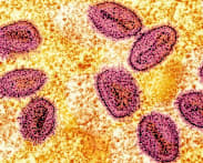Singapore confirms first two locally transmitted mpox cases; authorities say risk to public is low