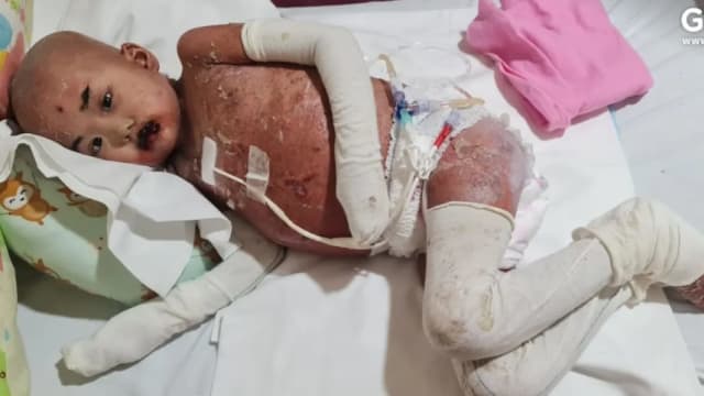 全身脱皮痛至哭喊 印尼血癌女童来新治疗