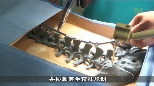 本地医院用人工智能辅助复杂脊椎手术 提高矫正精准度