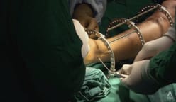 Is bone-breaking surgery to grow taller worth the risk?