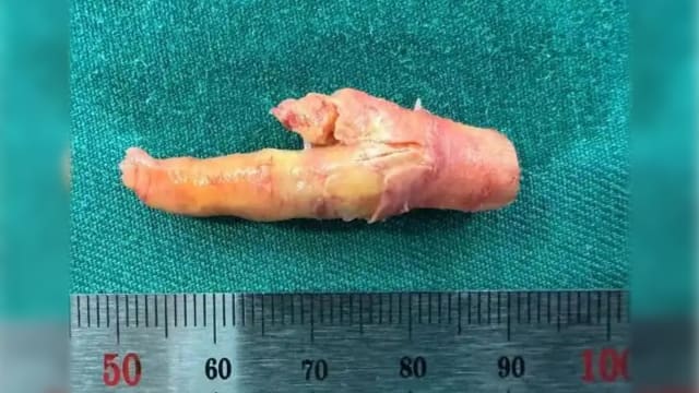 中国男子每天狂抽两包烟 医生从血管壁剥离一只“鸡爪”
