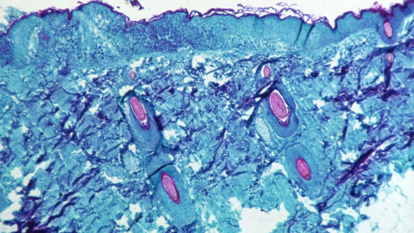 Monkeypox cases will be given isolation orders and can recover at home from Aug 22: MOH