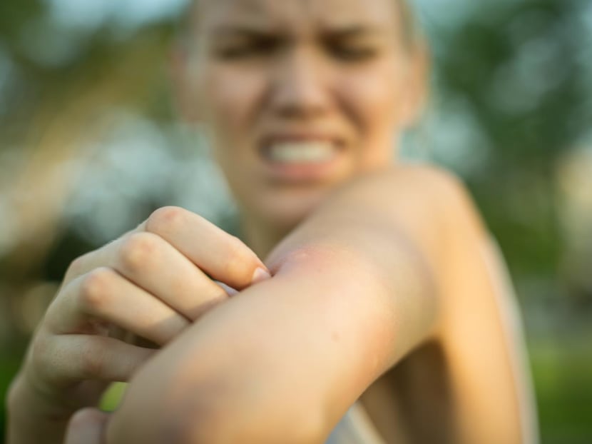 Fire ants, hornets, bed bugs: What to do if you get bitten or stung, and when to see a doctor Fire ants, hornets, bed bugs: What to do if you get bitten or stung, and when to see a doctor