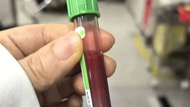 孕35周狂吃高油食物 母婴双双进ICU紧急剖腹