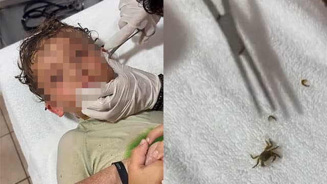 墨西哥男孩海边戏水后耳朵不适 医生夹出一只活螃蟹