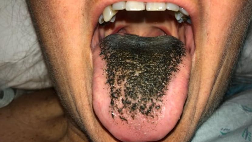 Apa sebenarnya 'rambut' hitam di lidah anda? Apa sebenarnya 'rambut' hitam di lidah anda?